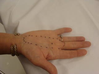 Preparing the hand for e-beam therapy of Dupuytrens disease