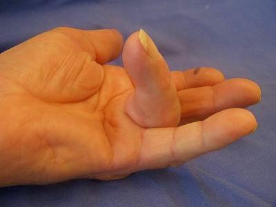 Dupuytren's contracture in very progressed stage:  the ring finger cannot be stretched anymore. In medical language this is called an extension deficit.