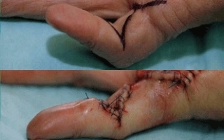 Fasciectomy of Dupuytren's contracture (Dupuytrens), before and after.