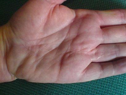 Palm three years after hand surgery of Dupuytren's contracture.  Straight finger, little scarring.